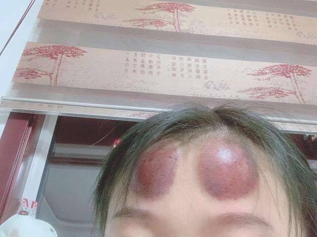 【灌水】那个告诉我拔罐能去头痛的人,你的良心不会疼